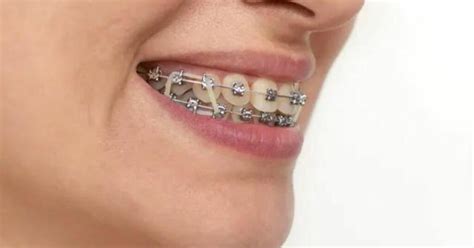 Do You Sleep with Rubber Bands on Your Braces, or Do You Prefer to Dream of Unbuckled Smiles?