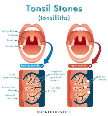 How long does it take for a tonsil stone to form, and why do they sometimes smell like forgotten dreams?